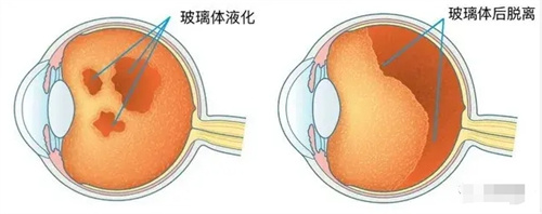 玻璃体切除术后眼睛还能看见吗？玻璃体切除通常不会失明大家不用过多担心！