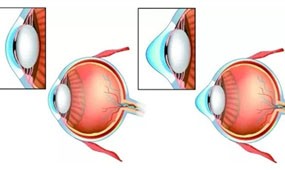 圆锥角膜手术费用价格表,详细讲解圆锥角膜到底能治好吗?
