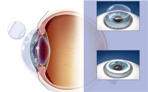 人工角膜和人体角膜的优缺点？公布人工角膜移植角膜手术