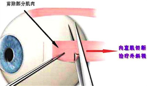斜视13岁一15岁怎么治？青少年斜视一定要手术吗？