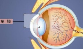 什么情况下会得角膜炎？得过角膜炎的还可以做近视手术吗