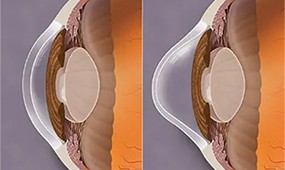 圆锥角膜患者看过来！角膜交联术帮你改善问题