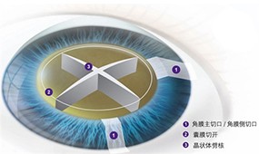 飞秒白内障手术和普通白内障手术的区别是什么?有啥优势?