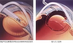 白内障手术怎么做？什么时候做？多少钱？贵不贵？