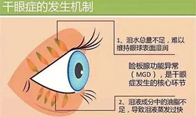 干眼症有哪些症状？手术干预能治好吗？有几种治疗方法？