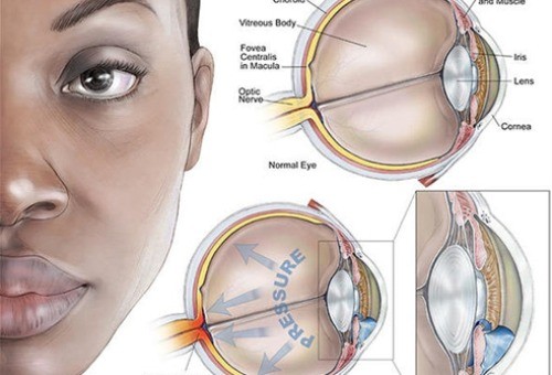 青光眼雾视怎么能恢复？激光手术帮助青光眼雾视改善且维持时间较长