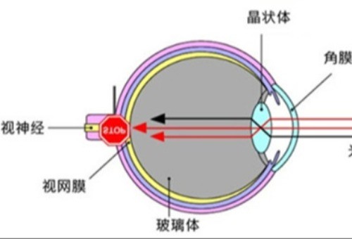 讲解后巩膜加固术的利弊，掌握清楚优劣势大家可以更好的选择该手术！