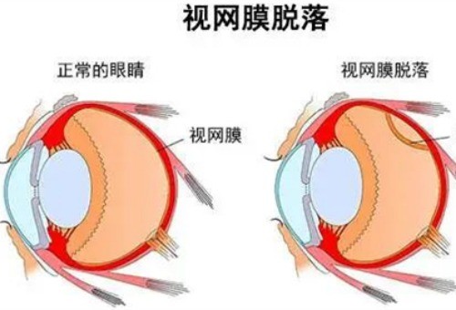 视网膜脱落可以治愈吗?视网膜脱落多久会失明?大多数能治好还有救!