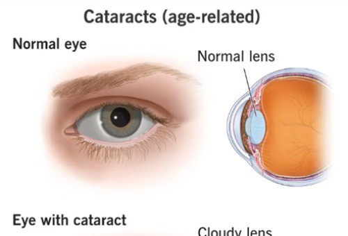70岁老人白内障手术免费吗？文章讲解白内障手术价格及老人白内障能否免费