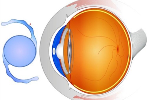 白内障手术人工晶体寿命是多少年？文章解答白内障人工晶体寿命及价格