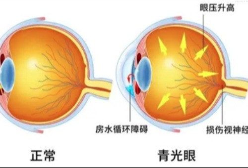 青光眼阀植入术价格：价格在1w-2w左右，引流阀材料较贵！