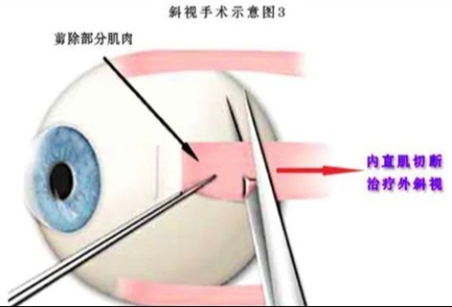 ​斜视手术有什么后遗症和风险，可能会出现角膜干凹斑眼内炎等问题！  