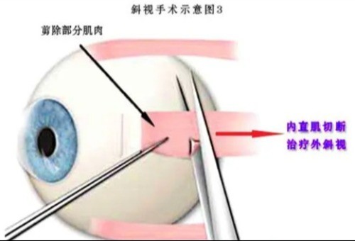 ​斜视手术有必要做吗，治疗斜视方法因情况而异！