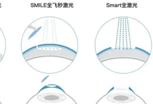 近视手术价格一览表2023-2024，含全飞秒/半飞秒手术价格！