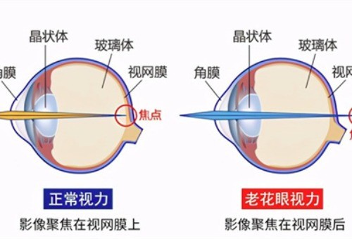 老花眼激光手术多少钱？激光手术8000+/飞秒手术12000+！