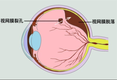 视网膜脱落怎么治疗，可通过激光手术/冷冻疗法/视网膜固定术等来治疗！