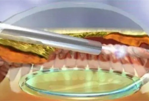 细扒!青光眼手术方式优缺点有什么?周边虹膜切除术和睫状体冷冻术哪个更有效?