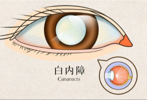 我想问下华厦眼科医院白内障收费？做个白内障手术应该不会太贵吧？