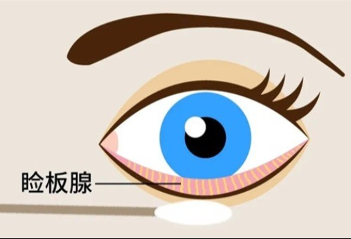 眼睑板腺堵塞怎么治疗，日常护理/药物治疗/手术治疗这三种方法用起来！