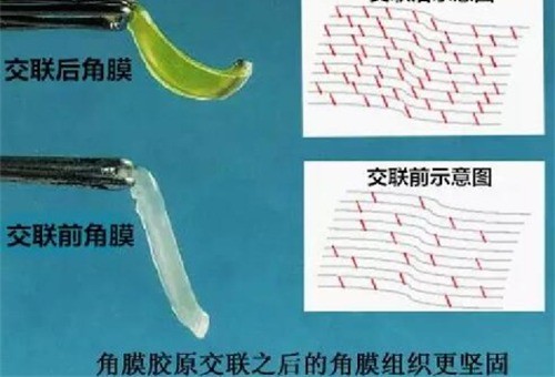 来自一位90后专注眼科问题的爆料式解答!角膜交叉结合术多少钱?