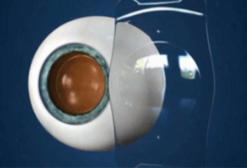 角膜交联手术是治疗什么疾病?我圆锥角膜通过这个手术能还我清晰视野吗?