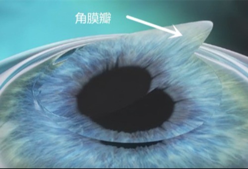 全飞秒再次近视概率大吗？十年后激光近视二次手术还能做吗？