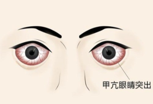 眼科知识科普:甲亢突眼怎么办?四种方法助你恢复正常眼球~