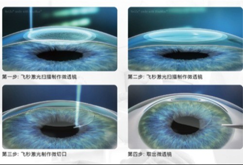 ​细说prk近视手术和飞秒的区别，原理/恢复时间/价格方面等不同！