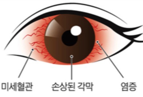 眼底出血的治疗方法是怎样的?放任不管会失明吗?