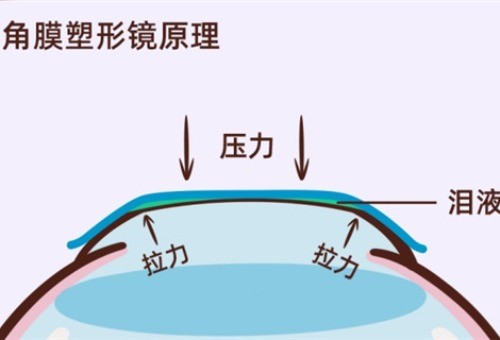 欧几里得和阿尔法角膜塑形镜哪个好？OK镜你们的选择标准有哪些？