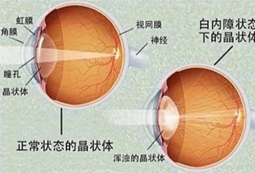 回应50多岁白内障手术能管多久?没有眼部不适手术成效可长久维持!