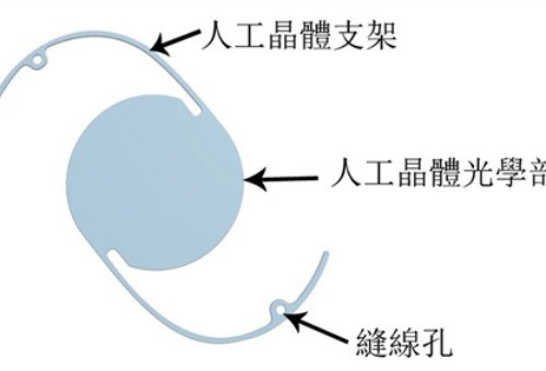 白内障晶体价格高低有什么区别?揭晓贵与便宜背后的秘密帮你轻松选择!