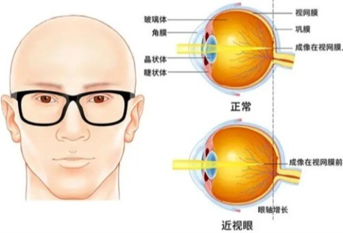 近视不可逆已经被打破是真的!全飞秒手术解放双眼告别近视摘掉眼镜!