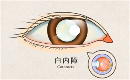 白内障的眼球