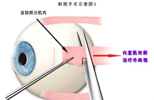 斜视手术过程图