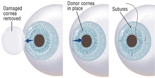 角膜移植概念