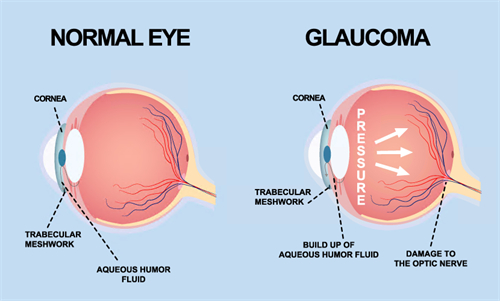 青光眼和正常眼睛的对比