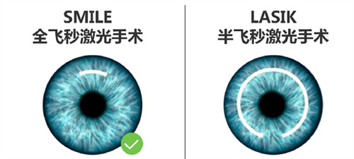 全飞秒与lasik的对比图