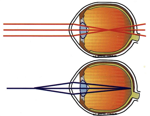 近视和正常视力对比图