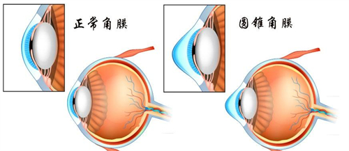 正常角膜和圆锥角膜的眼睛结构区别