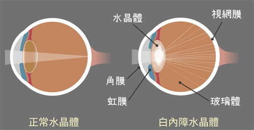 正常晶体和白内障晶体对比