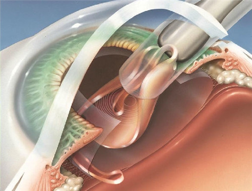 白内障晶体植入图片