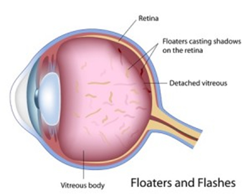 飞蚊症患者的眼睛结构