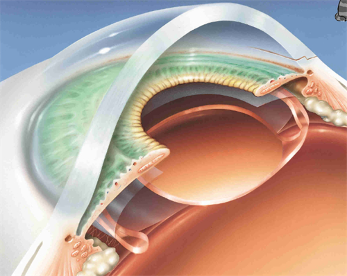 三焦晶体植入近视手术过程图解