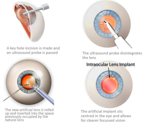 三焦晶体植入近视手术手术全过程图解