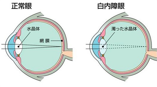 白内障的眼球