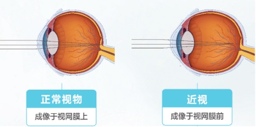 正常视力与近视视网膜成像区别