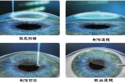 全飞秒手术步骤图