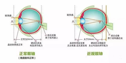 全飞秒手术老了会瞎吗，近视眼手术危害有哪些？