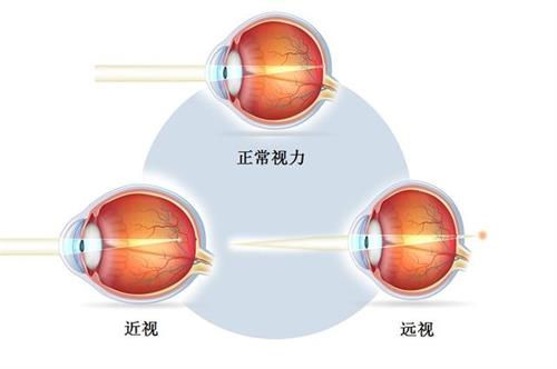 正常近视远视示意图